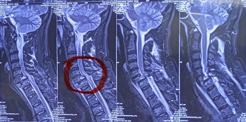 spinal surgery